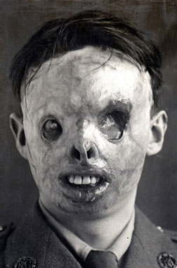 The terrible effect of mustard gas